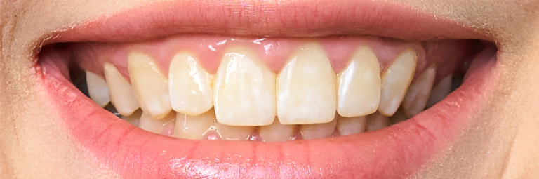 Rumeni zobje in kajenje